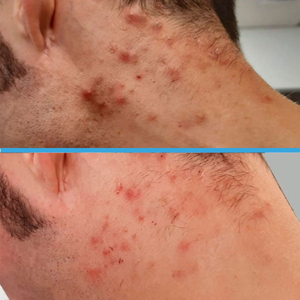 Resultado antes y después con láser azul Blauman — acné caso 1