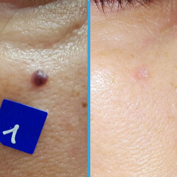 Resultado antes y después con láser azul Blauman — lesiones benignas caso 4