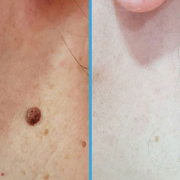 Resultado antes y después con láser azul Blauman — lesiones benignas caso 5