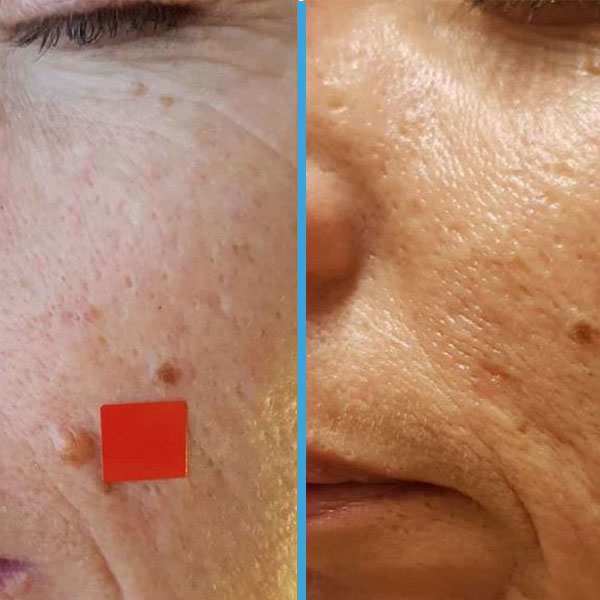 Resultado antes y después con láser azul Blauman — lesiones benignas caso 6