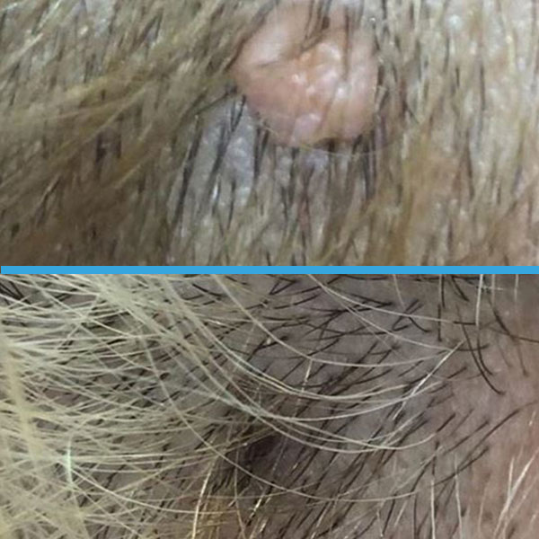 Resultado antes y después con láser azul Blauman — lesiones benignas caso 7