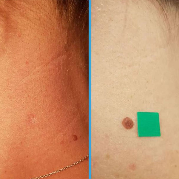 Resultado antes y después con láser azul Blauman — lesiones benignas caso 8