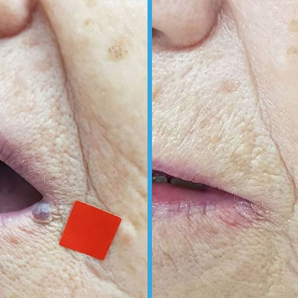 Resultado antes y después con láser azul Blauman — lesiones benignas caso 9
