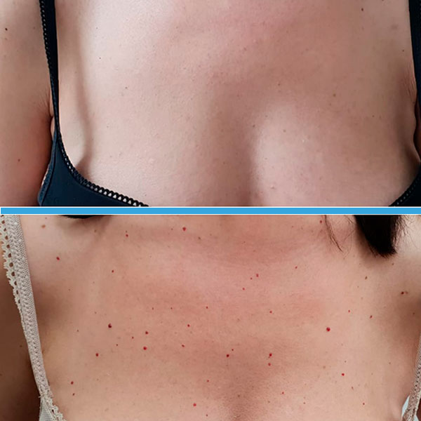 Resultado antes y después con láser azul Blauman — lesiones benignas caso 10