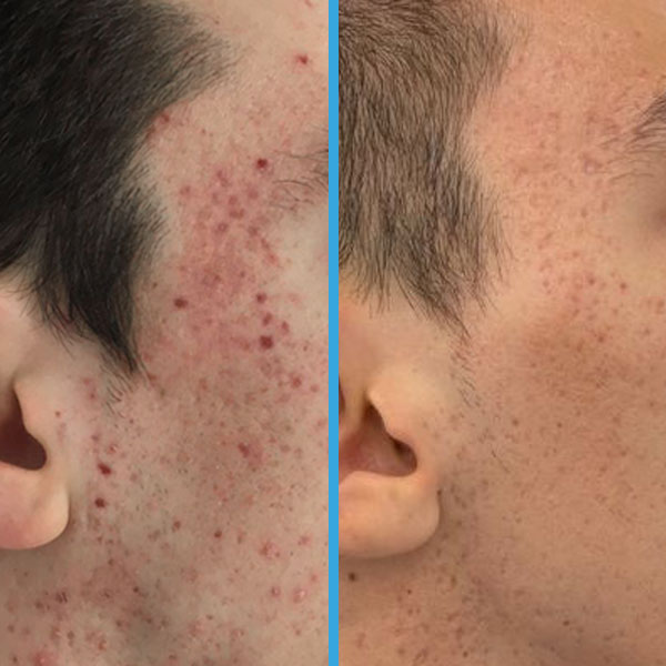 Resultado antes y después con láser azul Blauman — limpieza facial caso 25