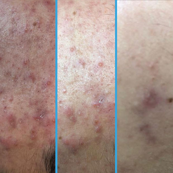 Resultado antes y después con láser azul Blauman — acné caso 2