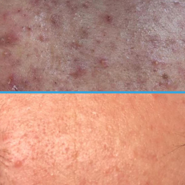Resultado antes y después con láser azul Blauman — acné caso 3