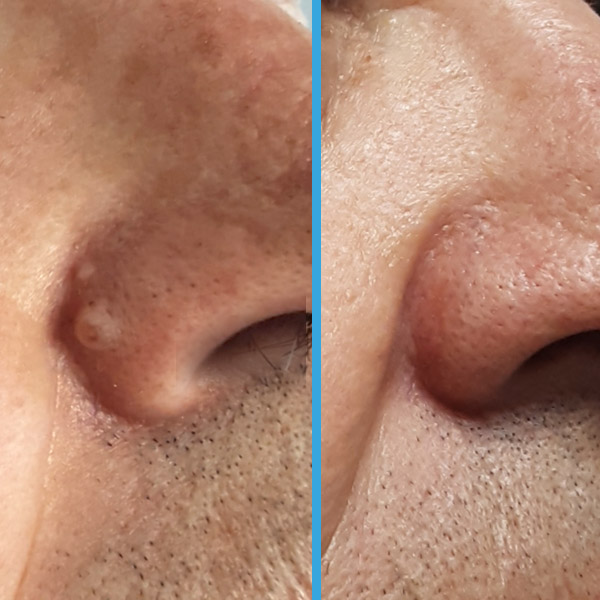 Resultado antes y después con láser azul Blauman — lesiones benignas caso 15