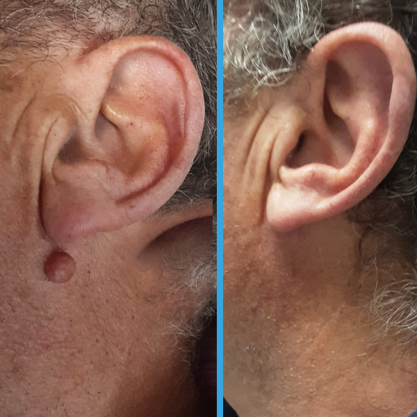 Resultado antes y después con láser azul Blauman — lesiones benignas caso 16